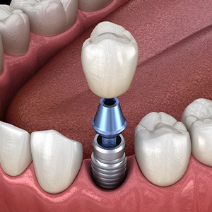 A 3D rendering of a single dental implant and crown