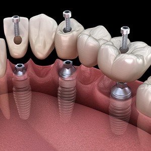 A 3D illustration of an implant bridge