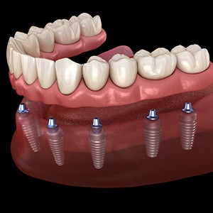 A 3D illustration of an implant denture