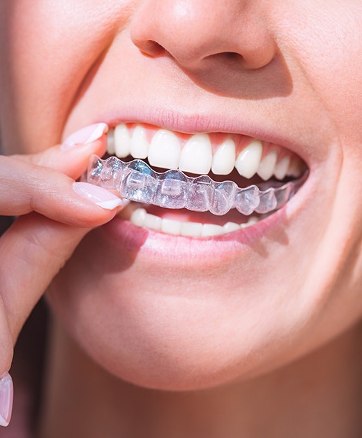 Woman putting in clear aligners