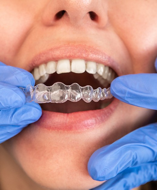 Woman getting clear aligners