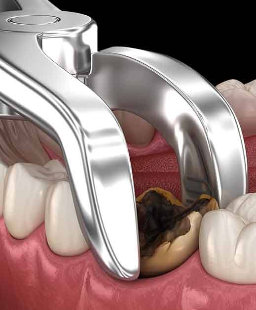 Digital image of decayed tooth being removed