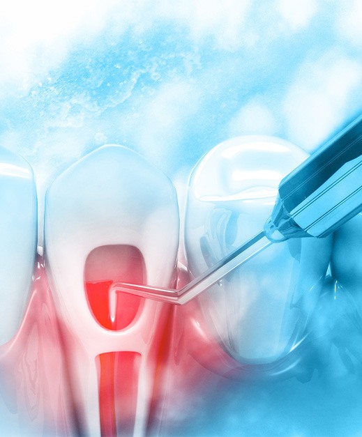 Illustration of tooth receiving root canal treatment