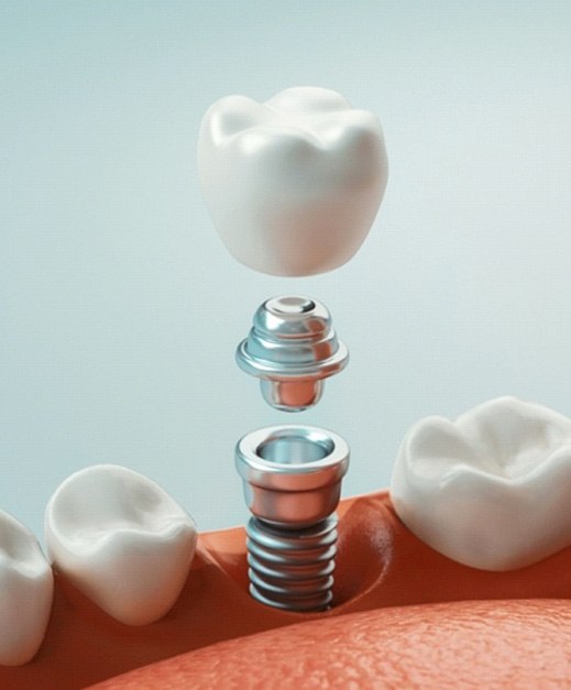 How dental implants work in Columbus
