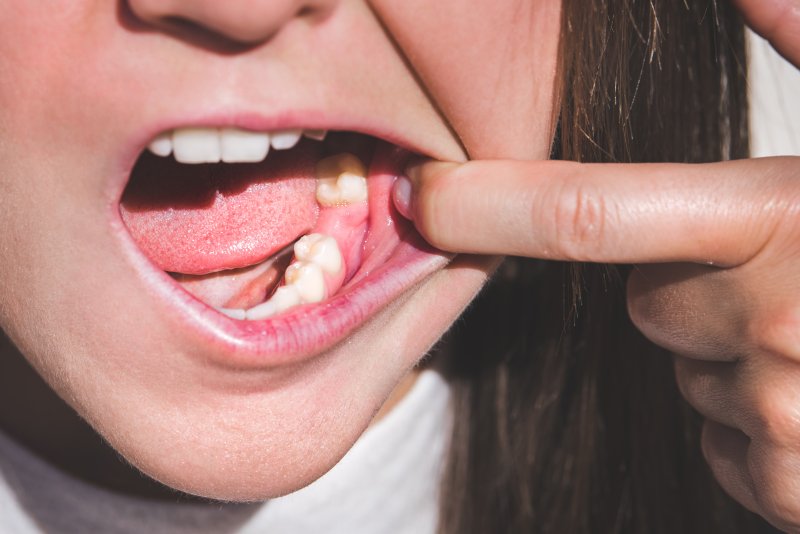 A young woman revealing an area without a tooth in her lower jaw.